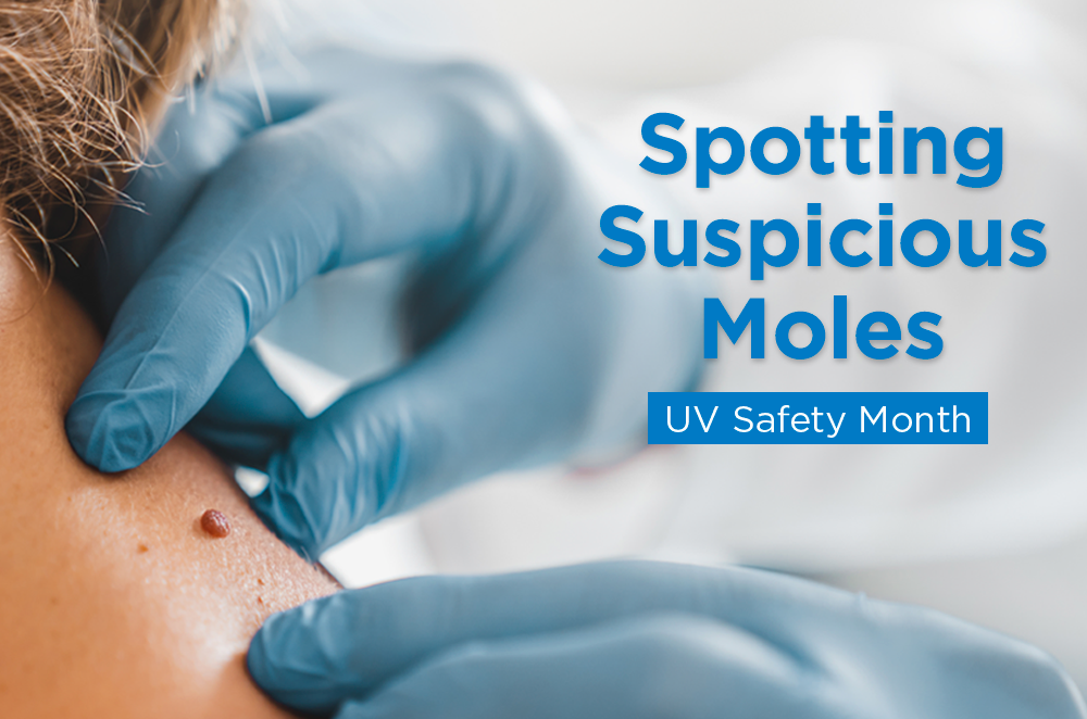 Spotting Suspicious Moles This UV Safety Month
